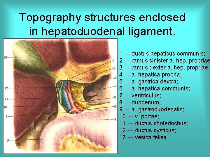 Topography structures enclosed in hepatoduodenal ligament. 1 — ductus hepaticus communis; 2 — ramus