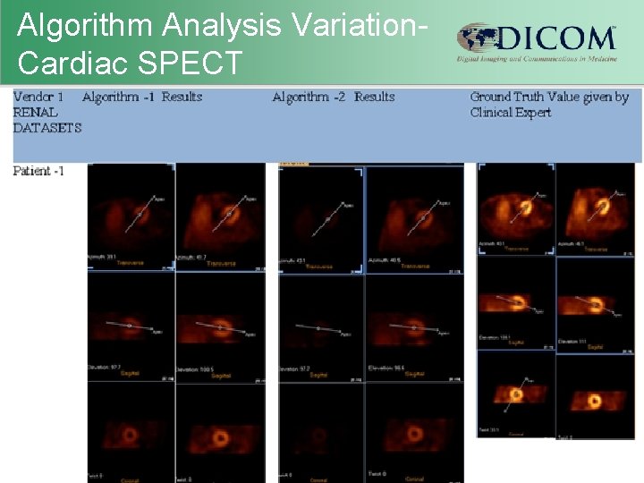 Algorithm Analysis Variation. Cardiac SPECT March 2013 DICOM International Conference & Seminar Title of