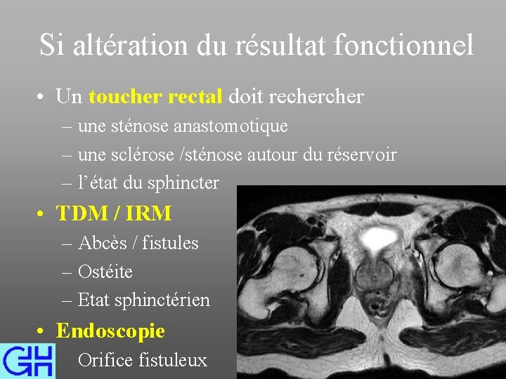 Si altération du résultat fonctionnel • Un toucher rectal doit recher – une sténose