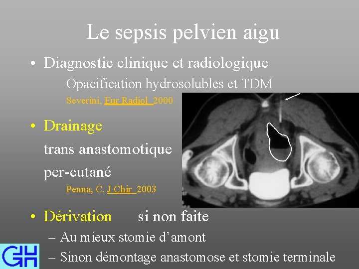 Le sepsis pelvien aigu • Diagnostic clinique et radiologique Opacification hydrosolubles et TDM Severini,