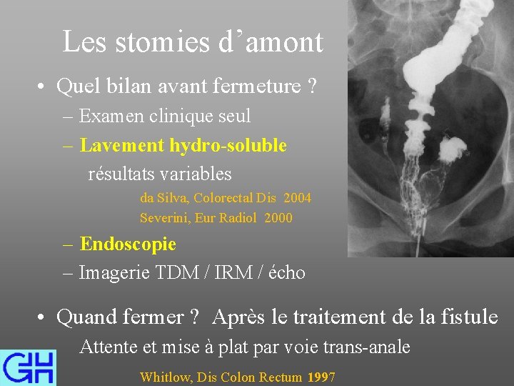 Les stomies d’amont • Quel bilan avant fermeture ? – Examen clinique seul –