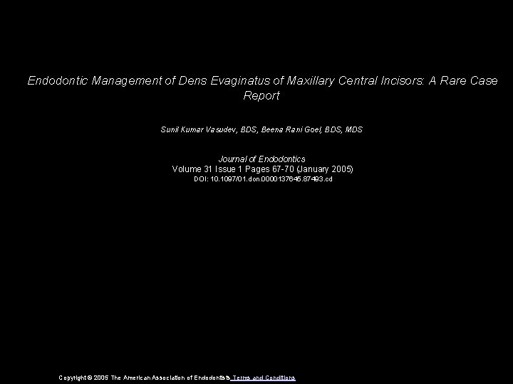 Endodontic Management of Dens Evaginatus of Maxillary Central Incisors: A Rare Case Report Sunil