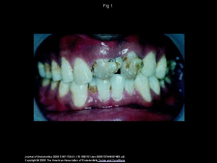 Fig 1 Journal of Endodontics 2005 3167 -70 DOI: (10. 1097/01. don. 0000137645. 87493.