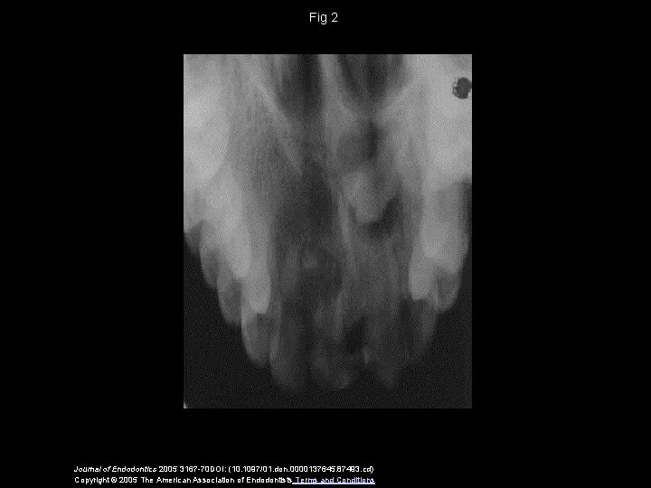 Fig 2 Journal of Endodontics 2005 3167 -70 DOI: (10. 1097/01. don. 0000137645. 87493.