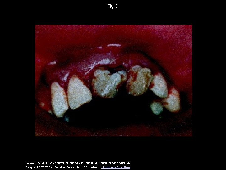 Fig 3 Journal of Endodontics 2005 3167 -70 DOI: (10. 1097/01. don. 0000137645. 87493.