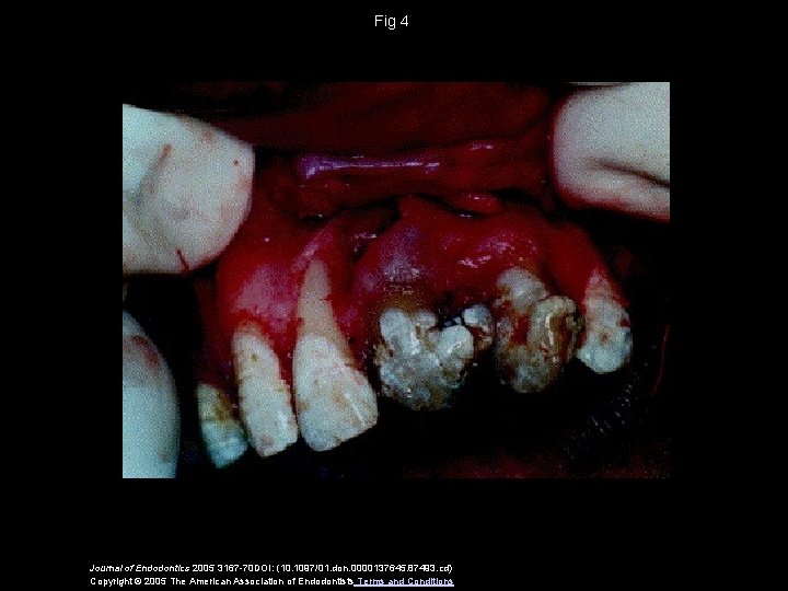 Fig 4 Journal of Endodontics 2005 3167 -70 DOI: (10. 1097/01. don. 0000137645. 87493.