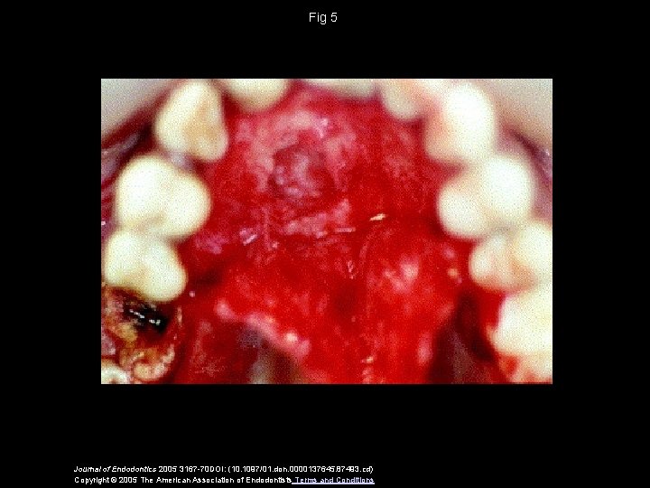 Fig 5 Journal of Endodontics 2005 3167 -70 DOI: (10. 1097/01. don. 0000137645. 87493.