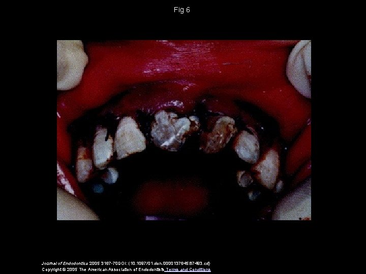 Fig 6 Journal of Endodontics 2005 3167 -70 DOI: (10. 1097/01. don. 0000137645. 87493.