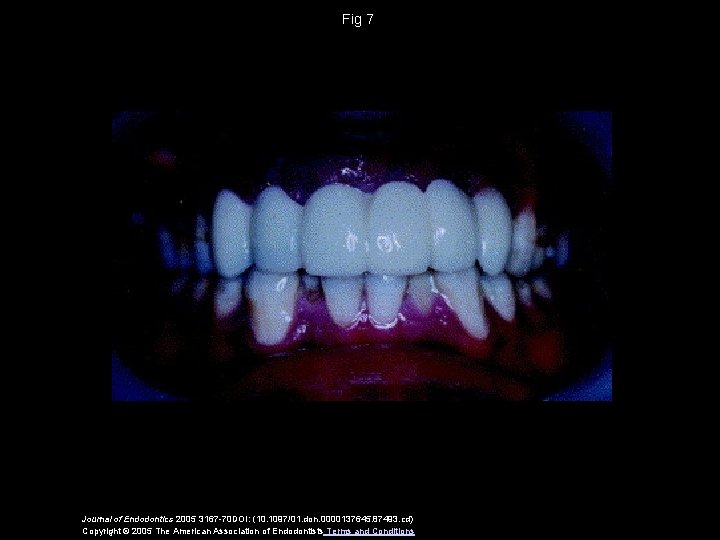 Fig 7 Journal of Endodontics 2005 3167 -70 DOI: (10. 1097/01. don. 0000137645. 87493.