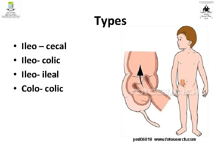 Types • • Ileo – cecal Ileo- colic Ileo- ileal Colo- colic 