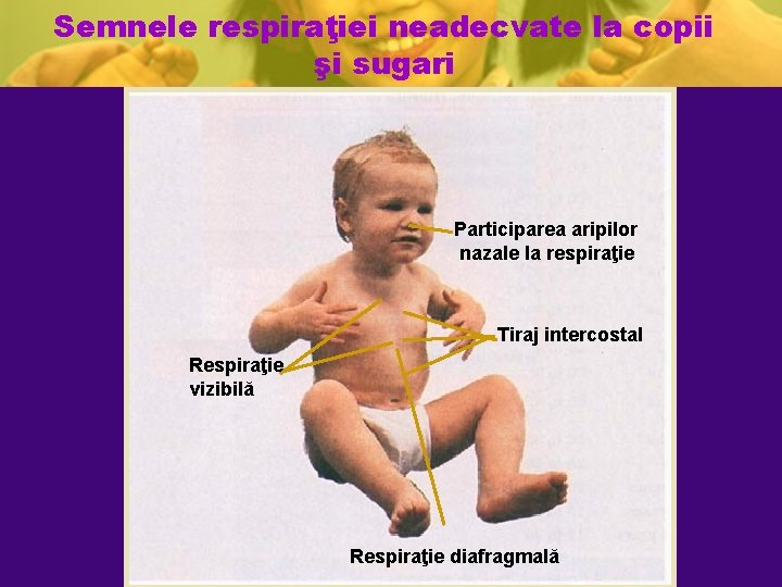 Semnele respiraţiei neadecvate la copii şi sugari Participarea aripilor nazale la respiraţie Tiraj intercostal Semnele respiraţiei neadecvate la copii şi sugari Participarea aripilor nazale la respiraţie Tiraj intercostal