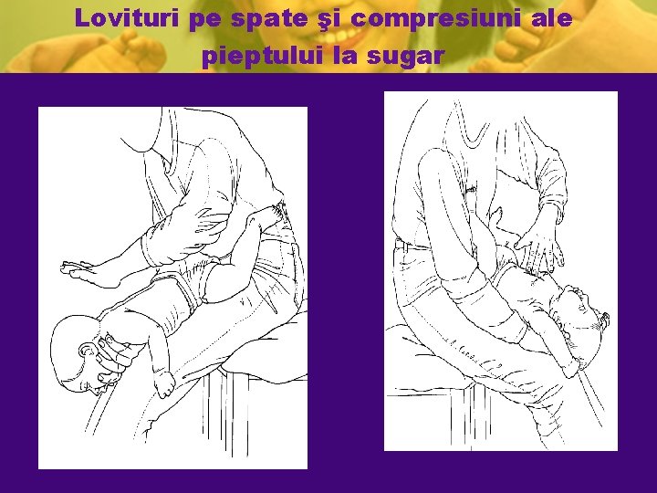 Lovituri pe spate şi compresiuni ale pieptului la sugar Lovituri pe spate şi compresiuni ale pieptului la sugar