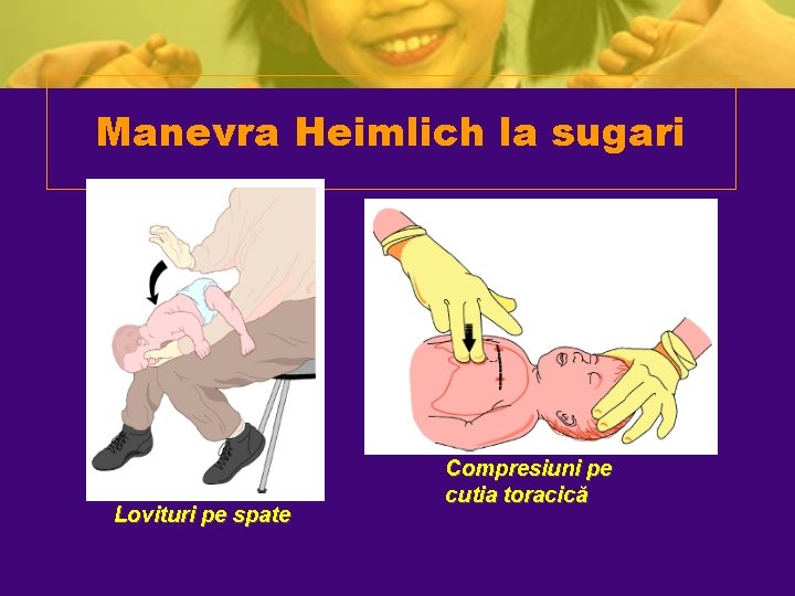 Manevra Heimlich la sugari Lovituri pe spate Compresiuni pe cutia toracică Manevra Heimlich la sugari Lovituri pe spate Compresiuni pe cutia toracică