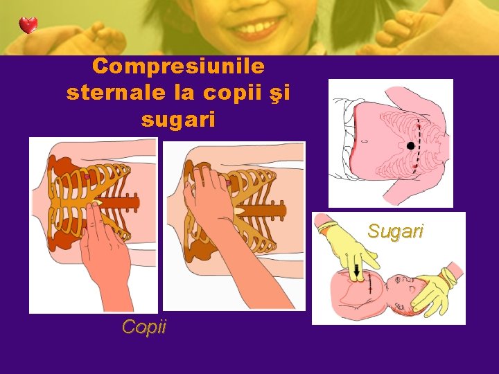Compresiunile sternale la copii şi sugari Sugari Copii Compresiunile sternale la copii şi sugari Sugari Copii