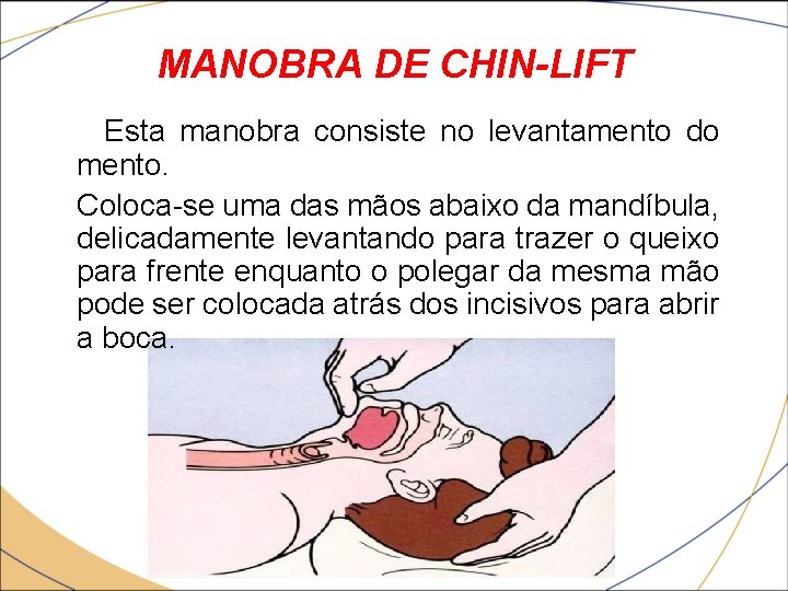 MANOBRA DE CHIN-LIFT • Esta manobra consiste no levantamento do mento. Coloca-se uma das