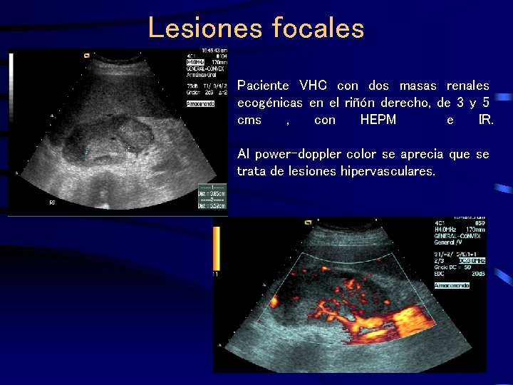 Lesiones focales Paciente VHC con dos masas renales ecogénicas en el riñón derecho, de