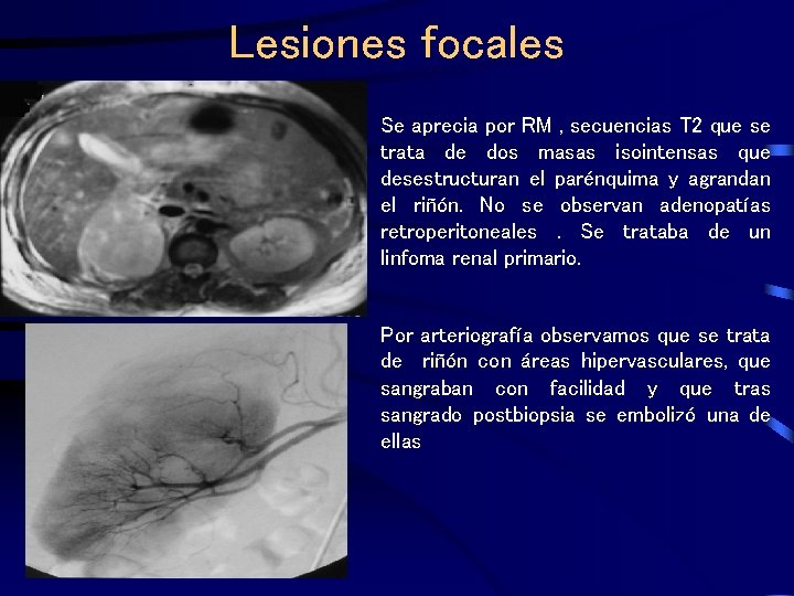 Lesiones focales Se aprecia por RM , secuencias T 2 que se trata de