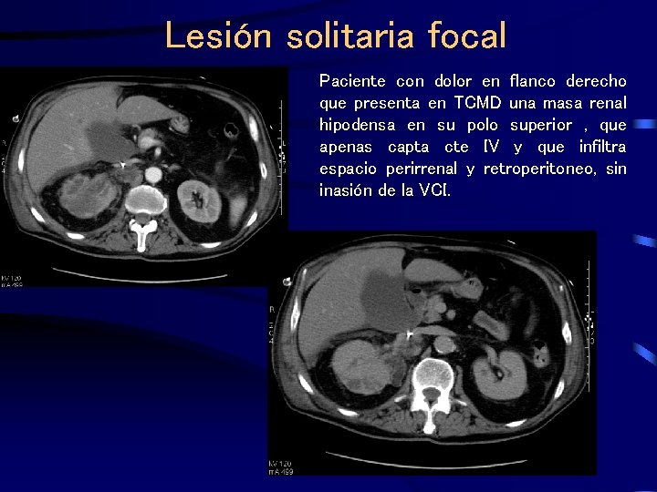 Lesión solitaria focal Paciente con dolor en flanco derecho que presenta en TCMD una