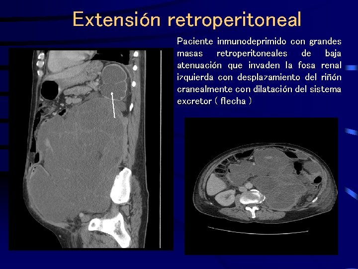 Extensión retroperitoneal Paciente inmunodeprimido con grandes masas retroperitoneales de baja atenuación que invaden la