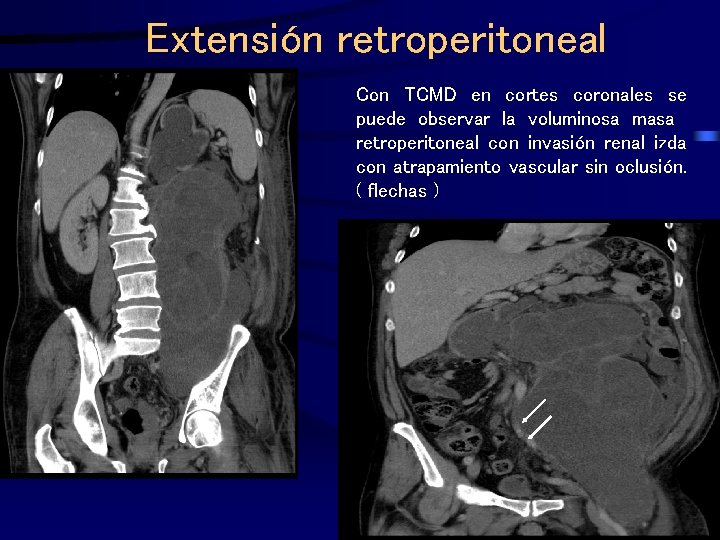 Extensión retroperitoneal Con TCMD en cortes coronales se puede observar la voluminosa masa retroperitoneal