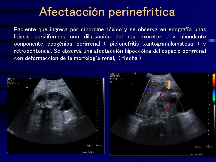 Afectacción perinefrítica Paciente que ingresa por síndrome tóxico y se observa en ecografía unas