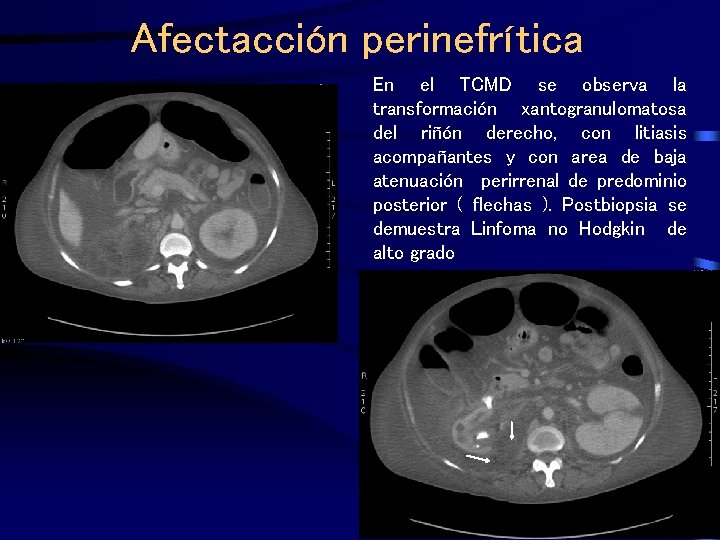 Afectacción perinefrítica En el TCMD se observa la transformación xantogranulomatosa del riñón derecho, con