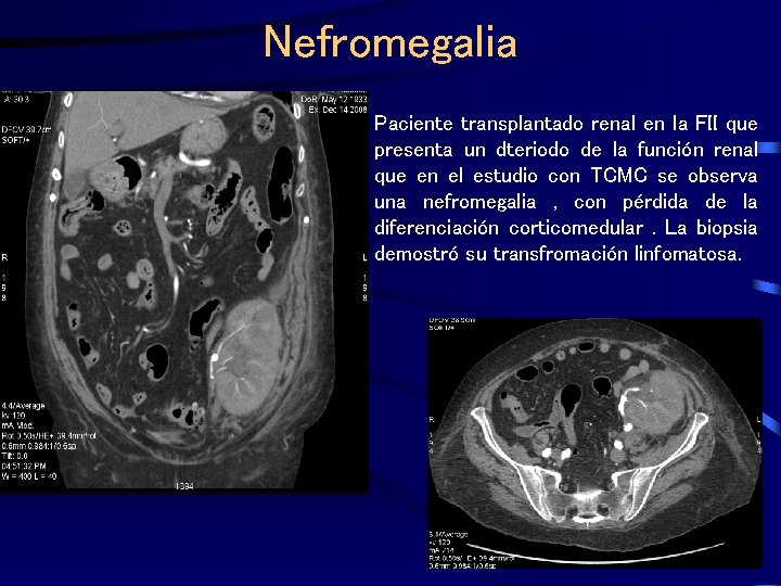 Nefromegalia Paciente transplantado renal en la FII que presenta un dteriodo de la función