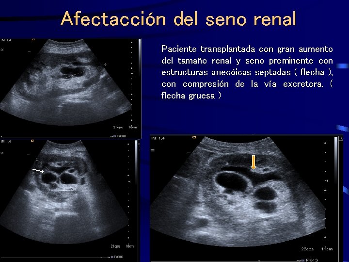 Afectacción del seno renal Paciente transplantada con gran aumento del tamaño renal y seno