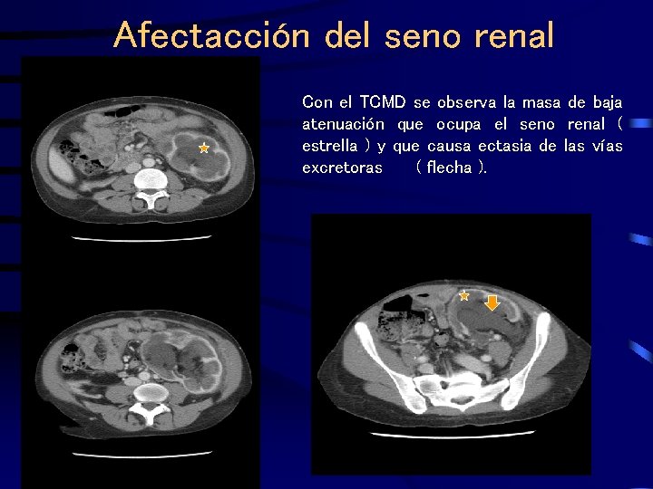 Afectacción del seno renal Con el TCMD se observa la masa de baja atenuación