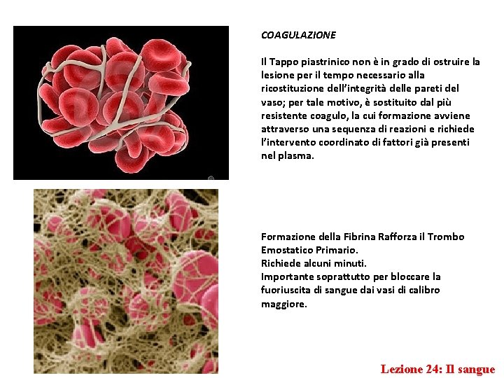 COAGULAZIONE Il Tappo piastrinico non è in grado di ostruire la lesione per il