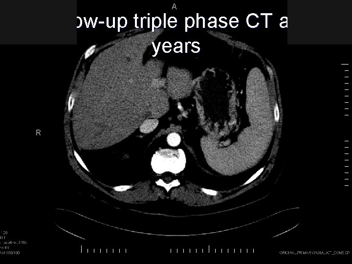 Follow-up triple phase CT at 2 years 