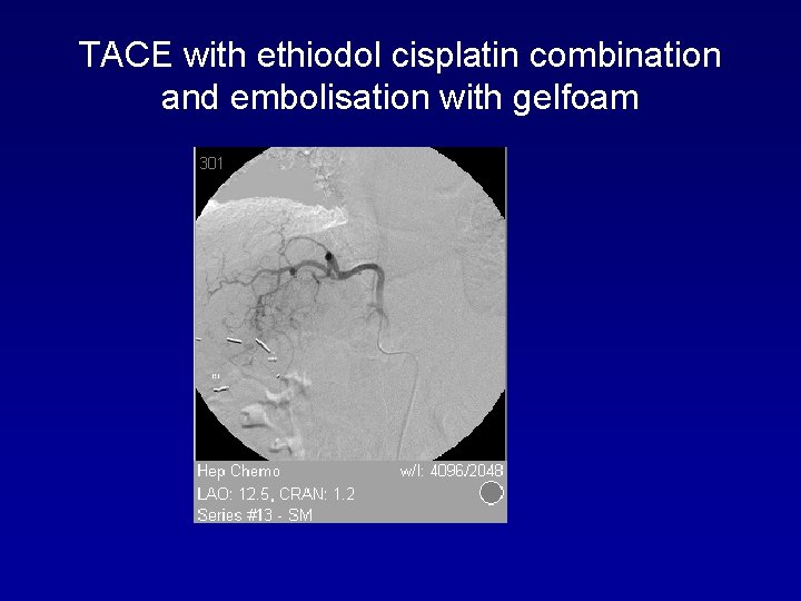 TACE with ethiodol cisplatin combination and embolisation with gelfoam 