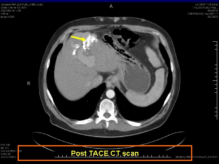 Post TACE CT scan 