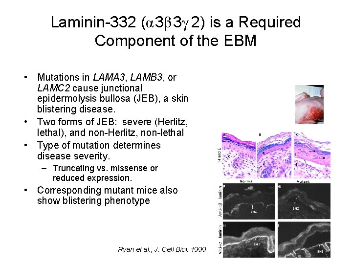 Laminin-332 (α 3β 3γ 2) is a Required Component of the EBM • Mutations