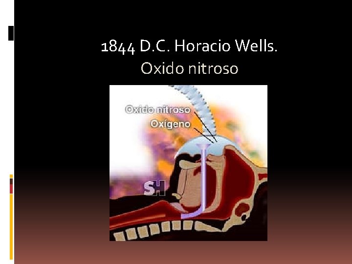 1844 D. C. Horacio Wells. Oxido nitroso 