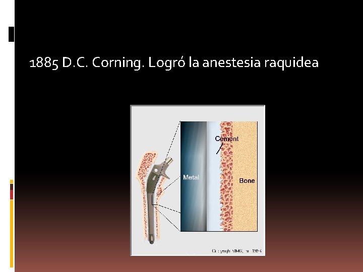 1885 D. C. Corning. Logró la anestesia raquidea 