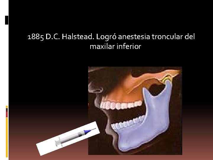 1885 D. C. Halstead. Logró anestesia troncular del maxilar inferior 