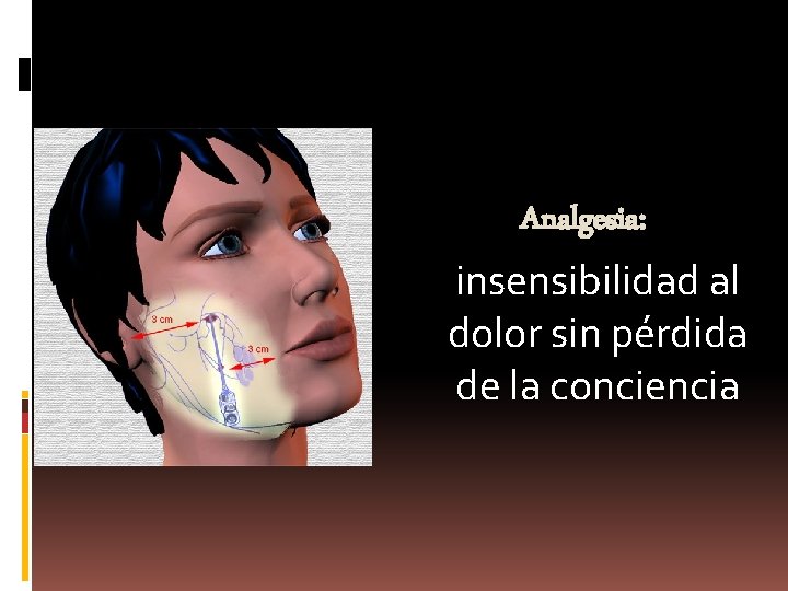 Analgesia: insensibilidad al dolor sin pérdida de la conciencia 