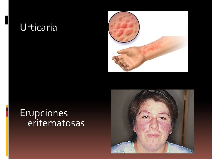 Urticaria Erupciones eritematosas 