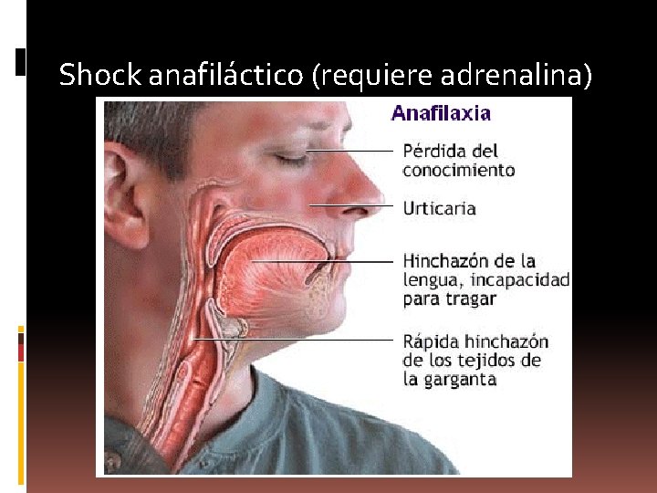 Shock anafiláctico (requiere adrenalina) 