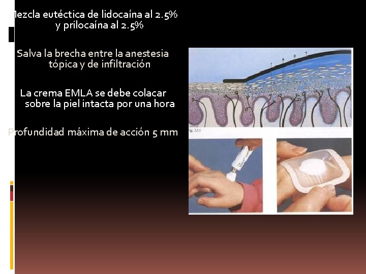 Mezcla eutéctica de lidocaína al 2. 5% y prilocaína al 2. 5% Salva la