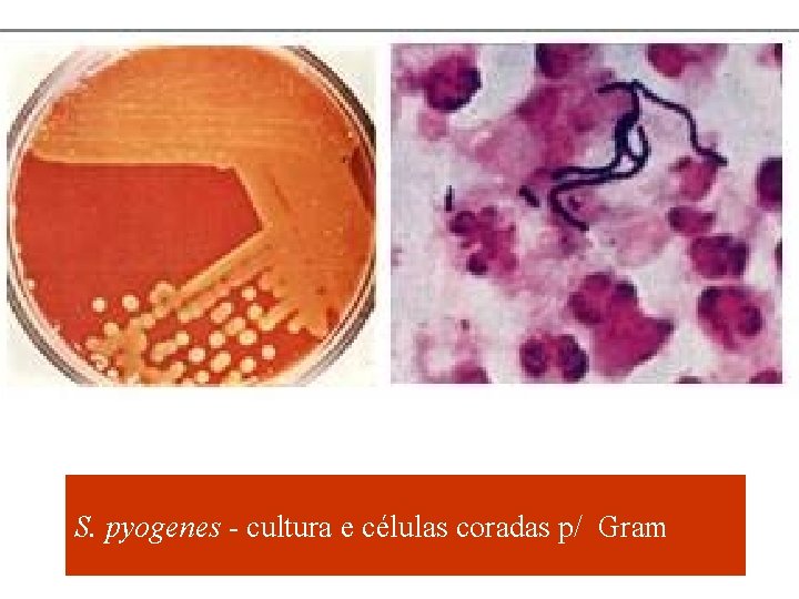 S. pyogenes - cultura e células coradas p/ Gram 