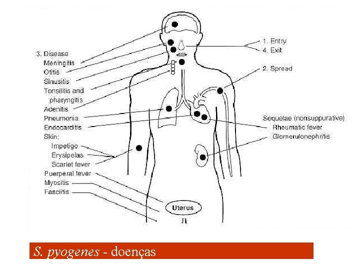 S. pyogenes - doenças 