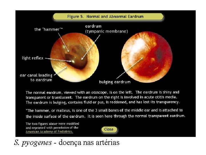 S. pyogenes - doença nas artérias 