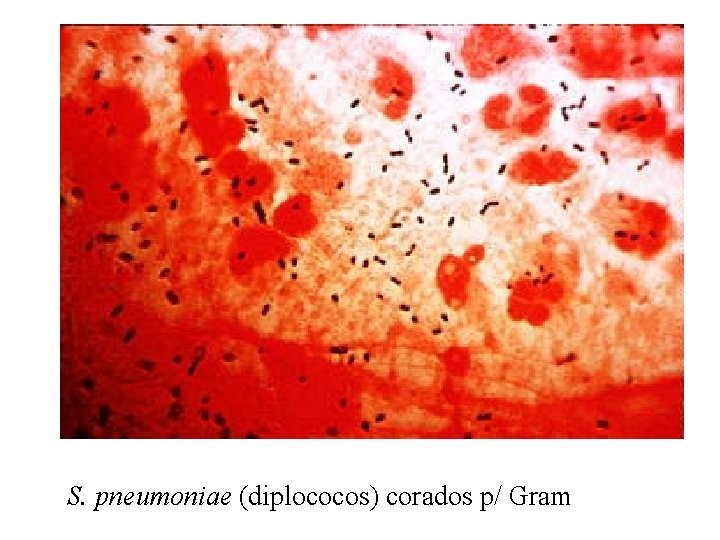 S. pneumoniae (diplococos) corados p/ Gram 