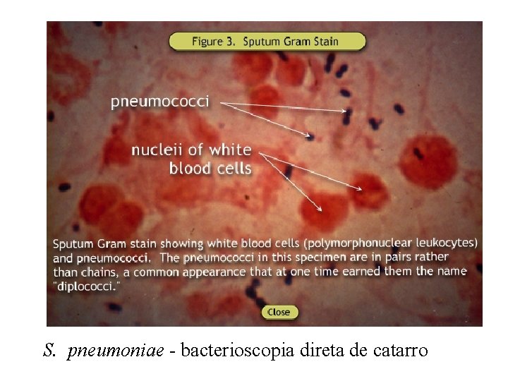 S. pneumoniae - bacterioscopia direta de catarro 