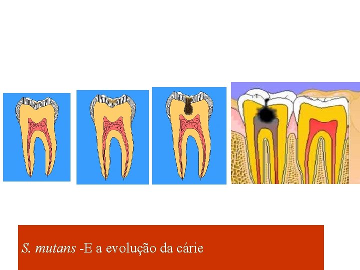 S. mutans -E a evolução da cárie 