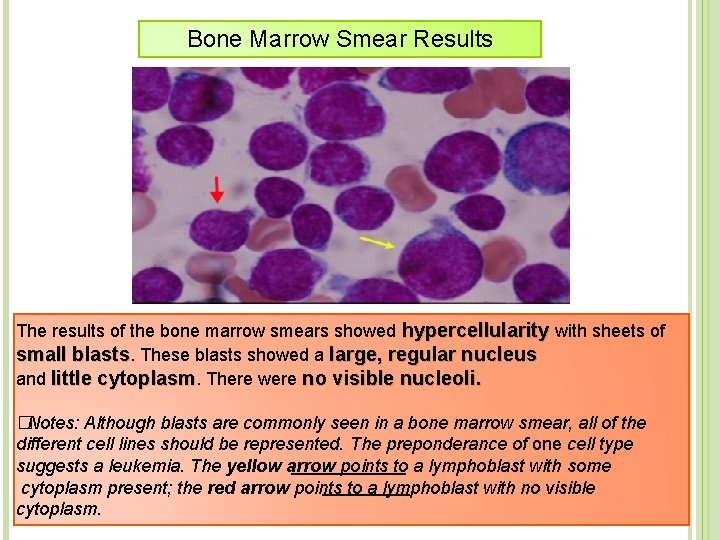 Bone Marrow Smear Results The results of the bone marrow smears showed hypercellularity with