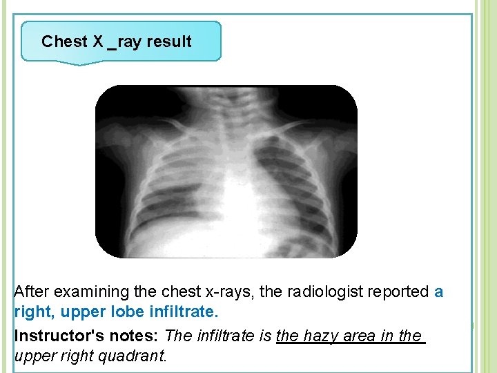  Chest X _ray result After examining the chest x-rays, the radiologist reported a