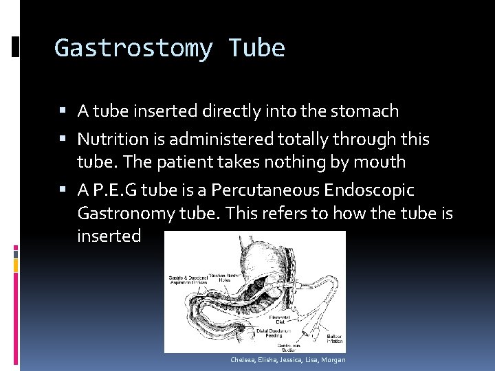 Gastrostomy Tube A tube inserted directly into the stomach Nutrition is administered totally through